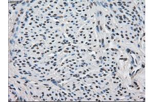 Immunohistochemical staining of paraffin-embedded Carcinoma of thyroid tissue using anti-FKBP5mouse monoclonal antibody. (FKBP5 抗体)