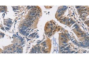 Immunohistochemistry of paraffin-embedded Human colon cancer using PGK1 Polyclonal Antibody at dilution of 1:50 (PGK1 抗体)