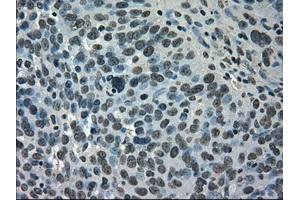 Immunohistochemical staining of paraffin-embedded Adenocarcinoma of breast tissue using anti-SATB1 mouse monoclonal antibody. (SATB1 抗体)
