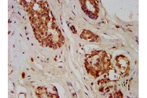 IHC image of ABIN7153745 diluted at 1:400 and staining in paraffin-embedded human breast cancer performed on a Leica BondTM system. (GMDS 抗体  (AA 243-346))