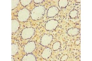Immunohistochemistry of paraffin-embedded human gastric cancer using ABIN7143774 at dilution of 1:100 (A4GNT 抗体  (AA 26-340))