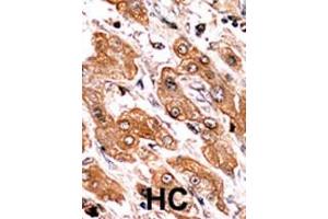 Formalin-fixed and paraffin-embedded human cancer tissue reacted with the primary antibody, which was peroxidase-conjugated to the secondary antibody, followed by AEC staining. (BIK 抗体  (pThr33))