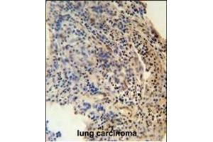 ZN antibody (N-term) (ABIN654489 and ABIN2844223) immunohistochemistry analysis in formalin fixed and paraffin embedded human lung carcinoma followed by peroxidase conjugation of the secondary antibody and DAB staining. (ZNF197 抗体  (N-Term))