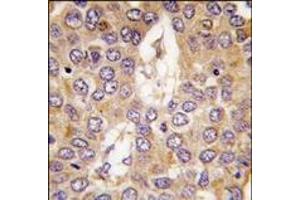 Formalin-fixed and paraffin-embedded human hepatocarcinoma tissue reacted with CK1g2 antibody (C-term), which was peroxidase-conjugated to the secondary antibody, followed by DAB staining. (Casein Kinase 1 gamma 2 抗体  (C-Term))