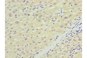 Immunohistochemistry of paraffin-embedded human liver cancer using ABIN7170048 at dilution of 1:100 (NKAIN4 抗体  (AA 83-150))