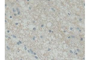 Detection of SNAP25 in Human Glioma Tissue using Polyclonal Antibody to Synaptosomal Associated Protein 25 kDa (SNAP25) (SNAP25 抗体  (AA 1-206))