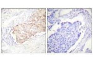 Immunohistochemistry analysis of paraffin-embedded human breast carcinoma tissue using EDD antibody. (UBR5 抗体)