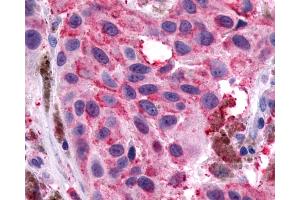 Anti-NPY1R antibody IHC of human Skin, Melanoma. (NPY1R 抗体  (Extracellular Domain))
