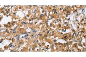 Immunohistochemistry of paraffin-embedded Human thyroid cancer using BCL10 Polyclonal Antibody at dilution of 1:40 (BCL10 抗体)