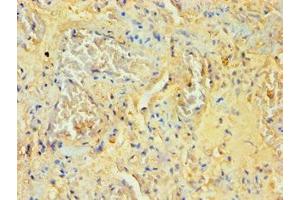 Immunohistochemistry of paraffin-embedded human lung tissue using ABIN7170995 at dilution of 1:100 (SOCS2 抗体  (AA 1-198))