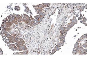 IHC-P Image Immunohistochemical analysis of paraffin-embedded human ovarian cancer, using NT5C2, antibody at 1:100 dilution. (NT5C2 抗体)