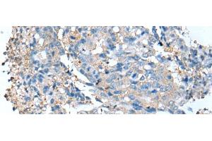 Immunohistochemistry of paraffin-embedded Human colorectal cancer tissue using DCX Polyclonal Antibody at dilution of 1:35(x200) (Doublecortin 抗体)