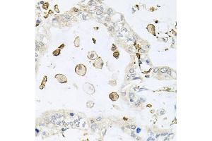 Immunohistochemistry of paraffin-embedded human gastric cancer using AIF1 antibody (ABIN5970719) at dilution of 1/100 (40x lens). (Iba1 抗体)