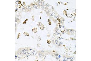 Immunohistochemistry of paraffin-embedded human gastric cancer using AIF1 antibody (ABIN5970719) at dilution of 1/100 (40x lens). (Iba1 抗体)