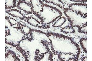 Immunohistochemical staining of paraffin-embedded Adenocarcinoma of Human colon tissue using anti-MLF1 mouse monoclonal antibody. (MLF1 抗体)