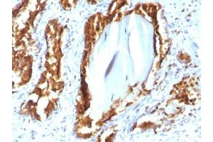 IHC testing of human prostate carcinoma with recombinant PSAP antibody (clone rACPP/1338). (Prosaposin 抗体)