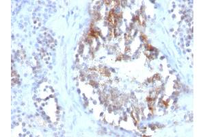 Formalin-fixed, paraffin-embedded human Testicular Carcinoma stained with SHBG Monoclonal Antibody (SPM605) (SHBG 抗体)
