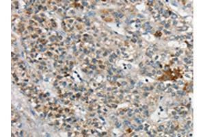 The image on the left is immunohistochemistry of paraffin-embedded Human liver cancer tissue using ABIN7192710(SYCP3 Antibody) at dilution 1/20, on the right is treated with synthetic peptide. (SYCP3 抗体)