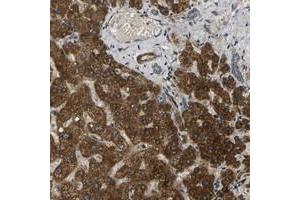 Immunohistochemical staining of human liver with FUT11 polyclonal antibody  shows strong cytoplasmic positivity in hepatocytes at 1:50-1:200 dilution.