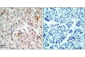 Immunohistochemistry analysis of paraffin-embedded human breast carcinoma tissue, using HER2 (Ab-1221/1222) Antibody. (ErbB2/Her2 抗体  (AA 1191-1240))