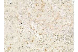 ABIN6265011 and ABIN6277522 at 1/100 staining human prostate carcinoma by IHC-P.