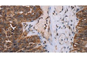 Immunohistochemistry of paraffin-embedded Human ovarian cancer tissue using DDX11 Polyclonal Antibody at dilution 1:30 (DDX11 抗体)
