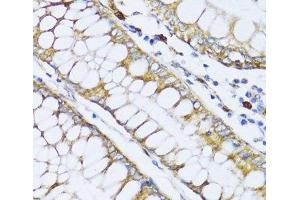 Immunohistochemistry of paraffin-embedded Human colon carcinoma using ALOX12 Polyclonal Antibody at dilution of 1:100 (40x lens). (ALOX12 抗体)
