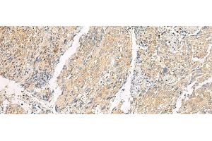 Immunohistochemistry of paraffin-embedded Human cervical cancer tissue using HEBP1 Polyclonal Antibody at dilution of 1:60(x200) (HEBP1 抗体)
