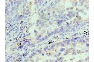 Immunohistochemistry of paraffin-embedded human lung cancer using ABIN7156833 at dilution of 1:100 (IL18RAP 抗体  (AA 390-599))