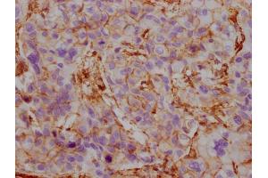 IHC image of ABIN7180354 diluted at 1:100 and staining in paraffin-embedded human liver cancer performed on a Leica BondTM system. (ACTB/POTEKP/ACTG1 抗体)
