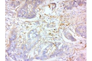 Formalin-fixed and paraffin embedded human lung carcinoma labeled with Anti-MMP-2 Polyclonal Antibody, Unconjugated  at 1:200 followed by conjugation to the secondary antibody and DAB staining. (MMP2 抗体  (AA 401-500))