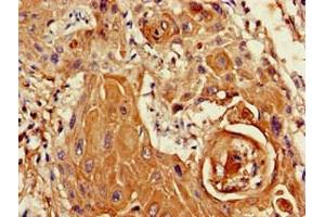 Immunohistochemistry of paraffin-embedded human cervical cancer using ABIN7169412 at dilution of 1:100 (SETD5 抗体  (AA 519-700))
