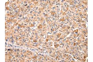 The image on the left is immunohistochemistry of paraffin-embedded Human liver cancer tissue using ABIN7192170(RERE Antibody) at dilution 1/20, on the right is treated with synthetic peptide. (RERE 抗体)