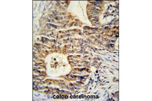 KLHL24 Antibody immunohistochemistry analysis in formalin fixed and paraffin embedded human colon carcinoma followed by peroxidase conjugation of the secondary antibody and DAB staining. (Kelch-Like 24 抗体  (AA 182-211))