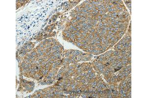 Immunohistochemistry of Human ovarian cancer using SLC16A1 Polyclonal Antibody at dilution of 1:50 (SLC16A1 抗体)