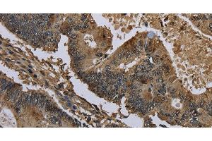 Immunohistochemistry of paraffin-embedded Human colon cancer using GSTO1 Polyclonal Antibody at dilution of 1:60 (GSTO1 抗体)