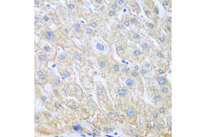 Immunohistochemistry of paraffin-embedded human liver cancer using PTGS1 antibody. (PTGS1 抗体)