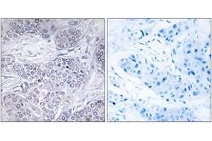 Immunohistochemistry analysis of paraffin-embedded human breast carcinoma tissue, using CEBPG Antibody. (CEBPG 抗体  (AA 31-80))