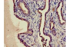 Immunohistochemistry of paraffin-embedded human prostate cancer using ABIN7169141 at dilution of 1:100 (PIM1 抗体  (AA 25-86))