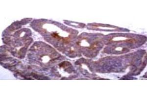 Immunohistochemical staining of TIMP1 on human colon carcinoma tissue with TIMP1 monoclonal antibody, clone 2A5 . (TIMP1 抗体)