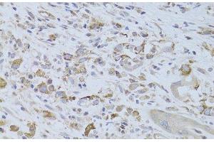 Immunohistochemistry of paraffin-embedded Human breast cancer using IGF2 Polyclonal Antibody at dilution of 1:100 (40x lens). (IGF2 抗体)