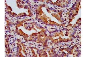 IHC image of ABIN7161158 diluted at 1:500 and staining in paraffin-embedded human lung cancer performed on a Leica BondTM system. (NPHP4 抗体  (AA 397-543))