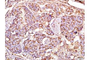 Paraformaldehyde-fixed, paraffin embedded human cervical cancer, Antigen retrieval by boiling in sodium citrate buffer (pH6) for 15min, Block endogenous peroxidase by 3% hydrogen peroxide for 30 minutes, Blocking buffer (normal goat serum) at 37°C for 20min, Antibody incubation with MAP1A Polyclonal Antibody, Unconjugated  ) at 1:500 overnight at 4°C, followed by a conjugated secondary and DAB staining.