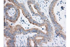 Immunohistochemical staining of paraffin-embedded Adenocarcinoma of Human colon tissue using anti-HIBCH mouse monoclonal antibody. (HIBCH 抗体)