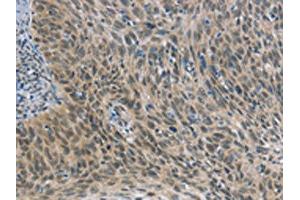 The image on the left is immunohistochemistry of paraffin-embedded Human cervical cancer tissue using ABIN7190689(FOXF1 Antibody) at dilution 1/25, on the right is treated with synthetic peptide. (FOXF1 抗体)