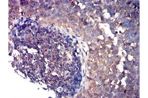 Immunohistochemical analysis of paraffin-embedded cervical cancer tissues using CD80 mouse mAb with DAB staining. (CD80 抗体  (AA 35-288))