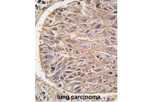 Formalin-fixed and paraffin-embedded human lung carcinoma tissue reacted with IKK beta antibody (ABIN1882097 and ABIN2842182) , which was peroxidase-conjugated to the secondary antibody, followed by DAB staining. (IKBKB 抗体)