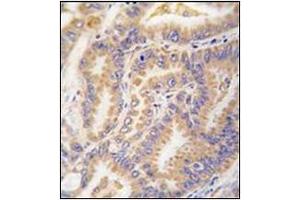 Formalin-fixed and paraffin-embedded human lung carcinoma tissue reacted with Autophagy APG12L Antibody (N-term), which was peroxidase-conjugated to the secondary antibody, followed by DAB staining. (ATG12 抗体  (N-Term))