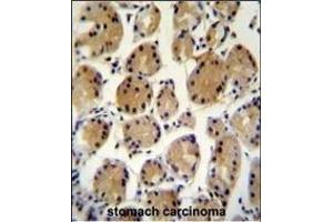 FAT10 Antibody (C-term) (ABIN655263 and ABIN2837857) immunohistochemistry analysis in formalin fixed and paraffin embedded human stomach carcinoma followed by peroxidase conjugation of the secondary antibody and DAB staining. (UBD 抗体  (C-Term))