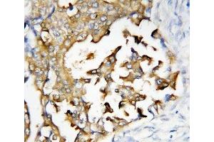 IHC-P: Presenilin 2 antibody testing of human breast cancer tissue (Presenilin 2 抗体  (N-Term))